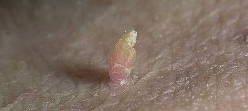 Papilloma στο πέος πώς να το αφαιρέσετε