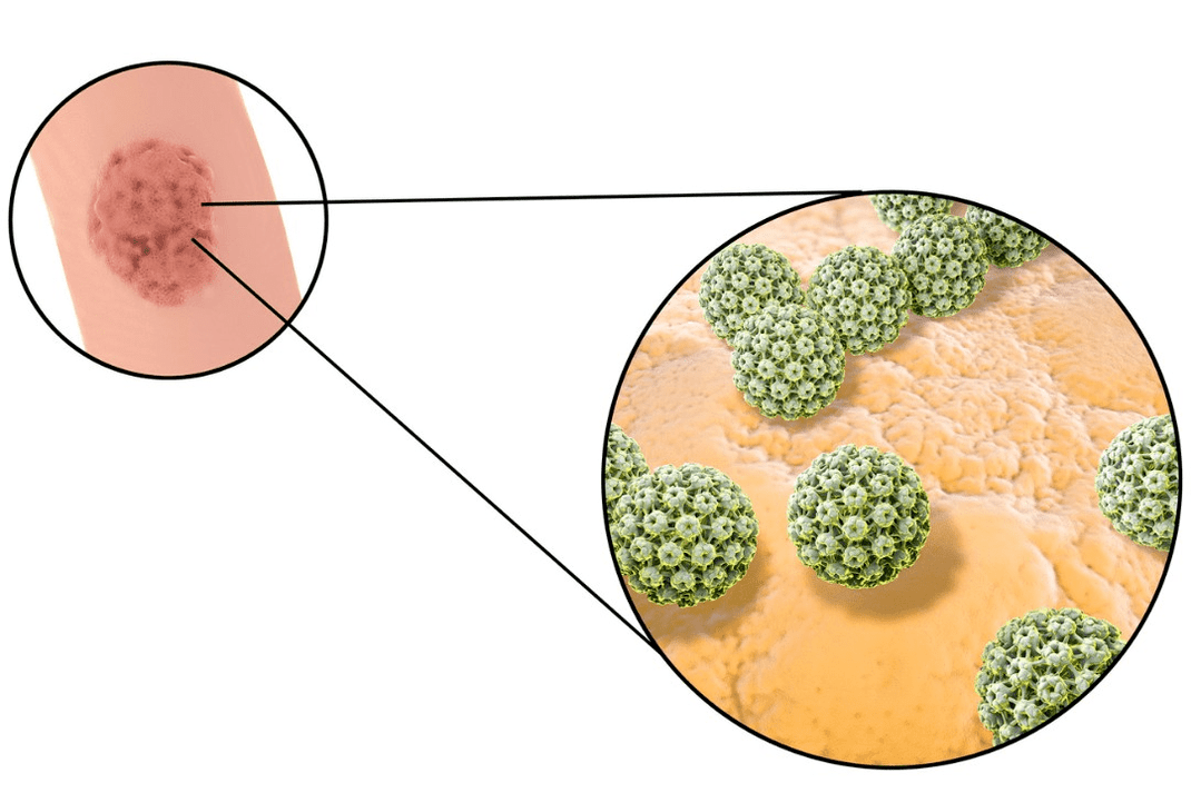 Πηγή μόλυνσης με ακανθοκυτταρικό θηλώμα